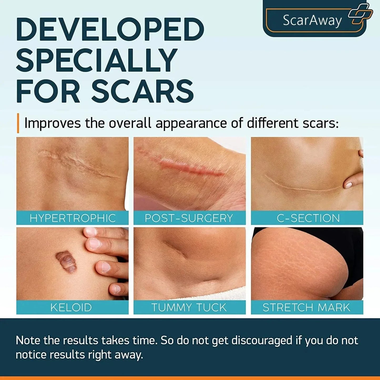 ScarAway®100% Advanced Scar Gel, cicatrices de cesárea, abdominoplastia, cicatrices antiguas, queloides, estrías, cicatrices de quemaduras.