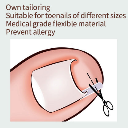 Ingrown Toenail Correction