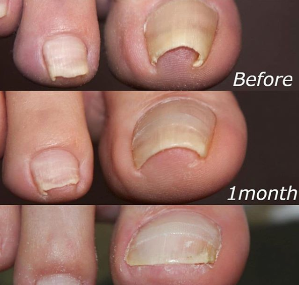 Nail Correction Patches