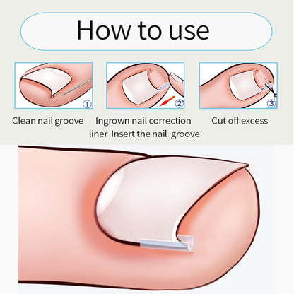 Ingrown Toenail Correction