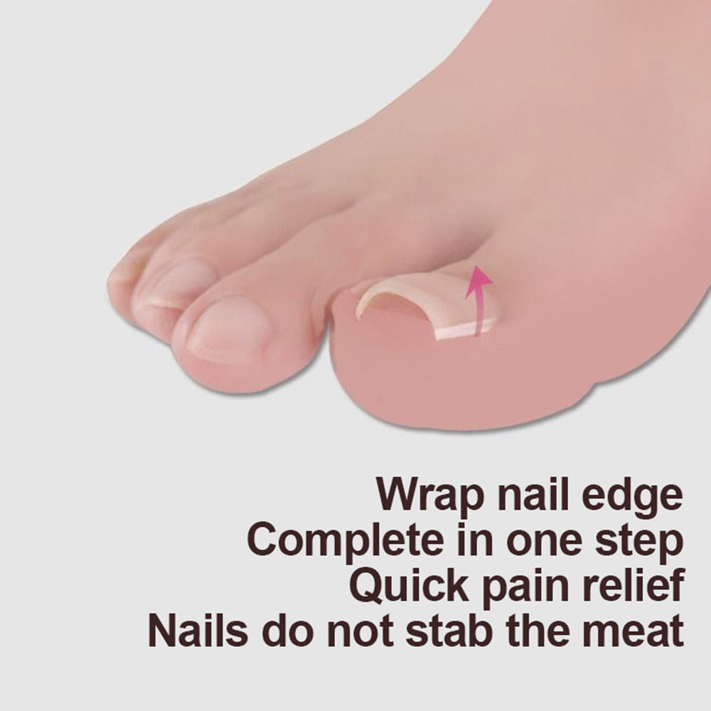 Ingrown Toenail Correction